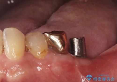 【インプラント】銀歯が取れて歯ごと折れたの治療中