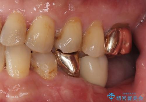 【インプラント】銀歯が取れて歯ごと折れたの治療後