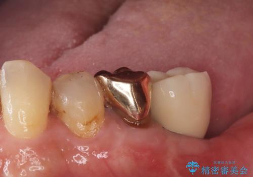 【インプラント】銀歯が取れて歯ごと折れたの治療後