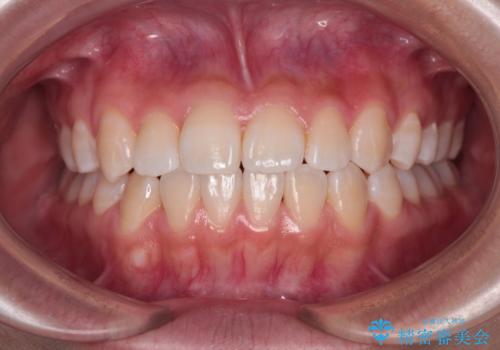 前歯のデコボコを楽して改善 ワイヤー装置による矯正治療の治療後