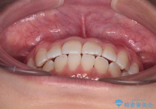 前歯のデコボコを楽して改善 ワイヤー装置による矯正治療の治療後