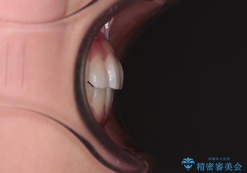 前歯のデコボコを楽して改善 ワイヤー装置による矯正治療の治療後