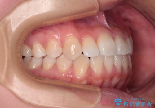 前歯のデコボコを楽して改善 ワイヤー装置による矯正治療の治療後