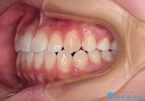 前歯のデコボコを楽して改善 ワイヤー装置による矯正治療の治療後