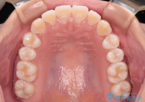 前歯のデコボコを楽して改善 ワイヤー装置による矯正治療の治療後