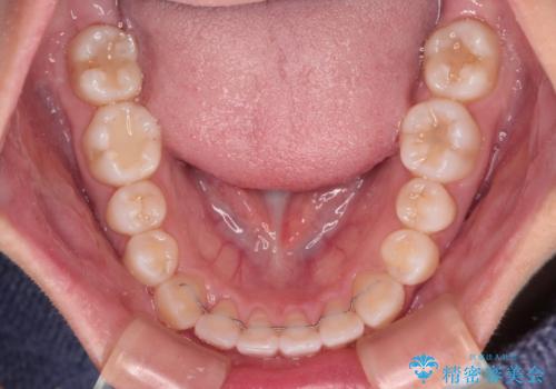 前歯のデコボコを楽して改善 ワイヤー装置による矯正治療の治療後