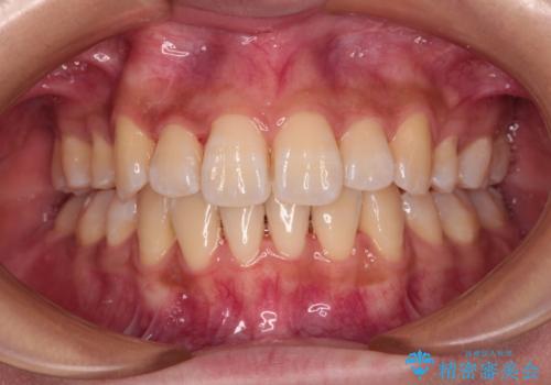 目立たないハーフリンガル矯正　抜歯矯正で口元の突出感を改善の症例 治療後
