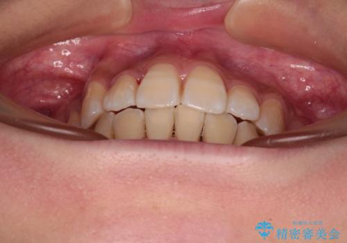目立たないハーフリンガル矯正 抜歯矯正で口元の突出感を改善の治療後