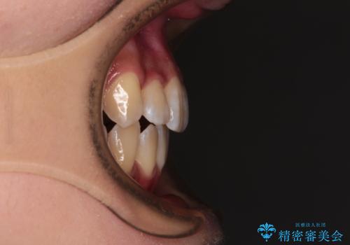 目立たないハーフリンガル矯正 抜歯矯正で口元の突出感を改善の治療後