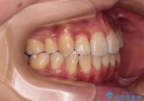 目立たないハーフリンガル矯正　抜歯矯正で口元の突出感を改善の治療後
