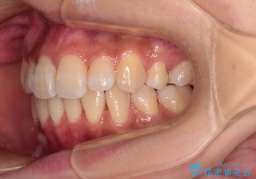 目立たないハーフリンガル矯正 抜歯矯正で口元の突出感を改善の治療後