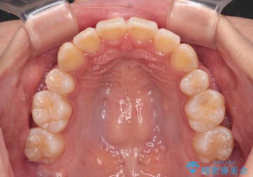 目立たないハーフリンガル矯正 抜歯矯正で口元の突出感を改善の治療後