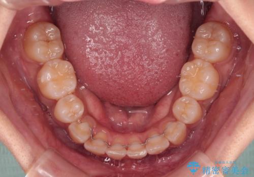 目立たないハーフリンガル矯正 抜歯矯正で口元の突出感を改善の治療後