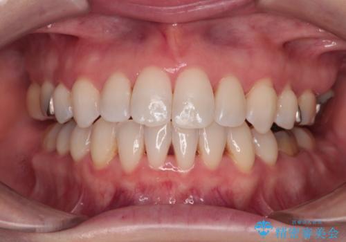 大きなむし歯の奥歯を抜歯してスペースを活用　ワイヤー装置による抜歯矯正の症例 治療後