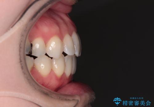 大きなむし歯の奥歯を抜歯してスペースを活用　ワイヤー装置による抜歯矯正の治療後