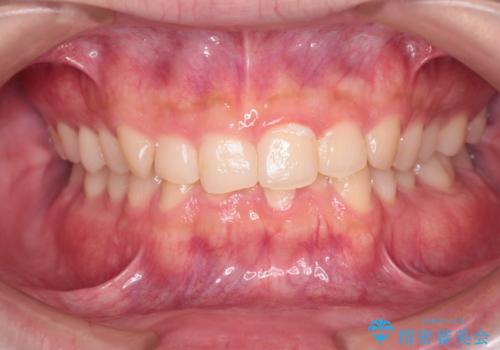【インビザライン】前歯のガタガタと、前歯の噛み合わせが深いことを治したい。の症例 治療前