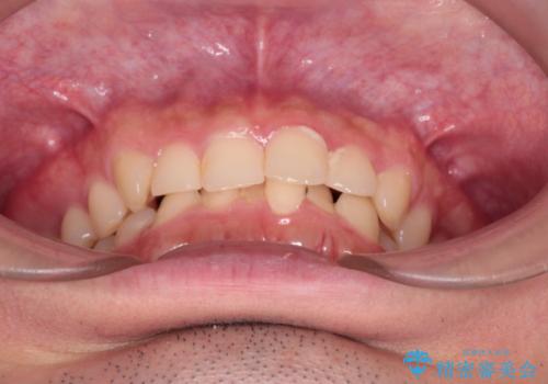 【インビザライン】前歯のガタガタと、前歯の噛み合わせが深いことを治したい。の治療前