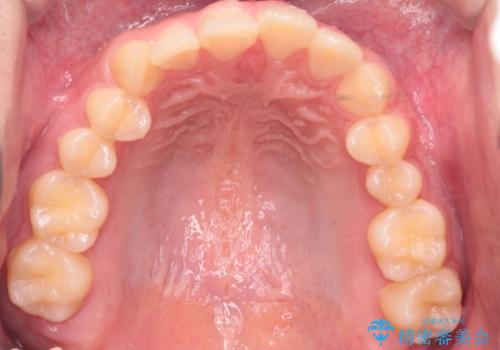【インビザライン】前歯のガタガタと、前歯の噛み合わせが深いことを治したい。の治療前