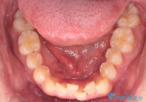 【インビザライン】前歯のガタガタと、前歯の噛み合わせが深いことを治したい。の治療前