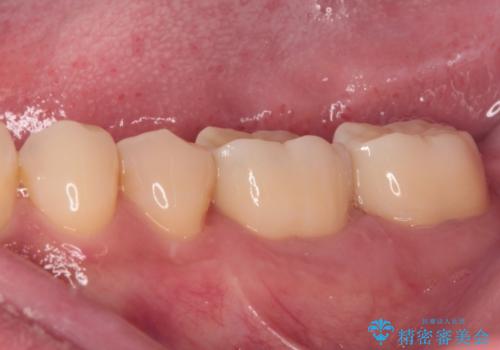 歯肉が腫れて出血する奥歯 歯周外科処置を用いたセラミック補綴治療の治療後