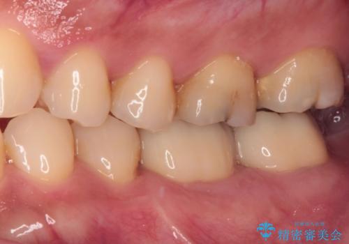 歯肉が腫れて出血する奥歯 歯周外科処置を用いたセラミック補綴治療の治療後