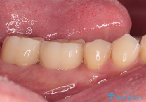 歯肉が腫れて出血する奥歯　歯周外科処置を用いたセラミック補綴治療の治療後