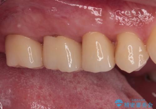 歯肉が腫れて出血する奥歯 歯周外科処置を用いたセラミック補綴治療の治療後