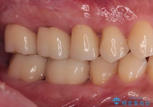 歯肉が腫れて出血する奥歯　歯周外科処置を用いたセラミック補綴治療の治療後