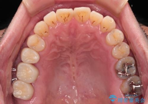 歯肉が腫れて出血する奥歯 歯周外科処置を用いたセラミック補綴治療の治療後