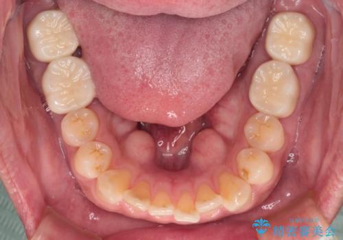 歯肉が腫れて出血する奥歯 歯周外科処置を用いたセラミック補綴治療の治療後