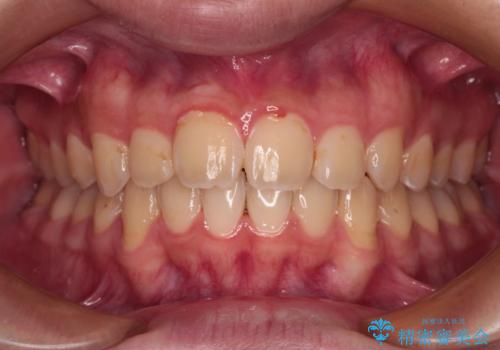 【モニター】飛び出した上の前歯 ワイヤー装置を併用してインビザラインできれいにの治療後