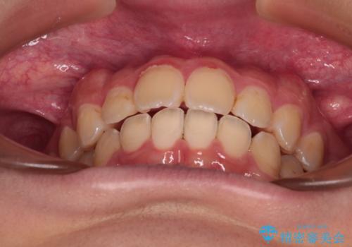 【モニター】飛び出した上の前歯 ワイヤー装置を併用してインビザラインできれいにの治療後