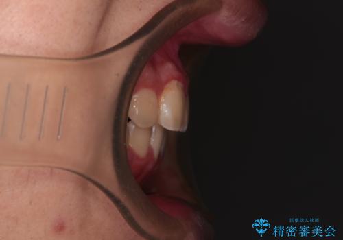 【モニター】飛び出した上の前歯 ワイヤー装置を併用してインビザラインできれいにの治療後