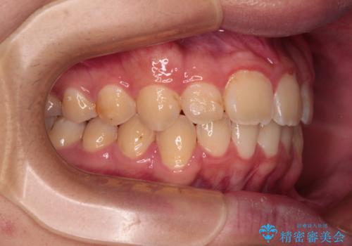 【モニター】飛び出した上の前歯 ワイヤー装置を併用してインビザラインできれいにの治療後