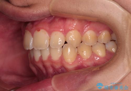 【モニター】飛び出した上の前歯 ワイヤー装置を併用してインビザラインできれいにの治療後