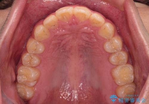 【モニター】飛び出した上の前歯 ワイヤー装置を併用してインビザラインできれいにの治療後