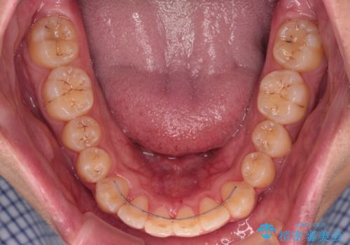 【モニター】飛び出した上の前歯 ワイヤー装置を併用してインビザラインできれいにの治療後