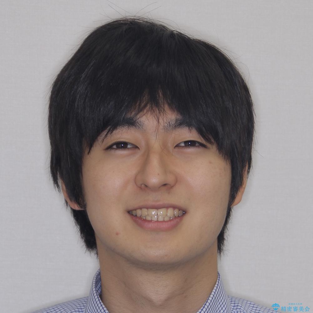 【モニター】飛び出した上の前歯 ワイヤー装置を併用してインビザラインできれいにの治療後(顔貌)