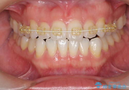 受け口傾向のマウスピース矯正 (ワイヤー治療を併用して)の治療中