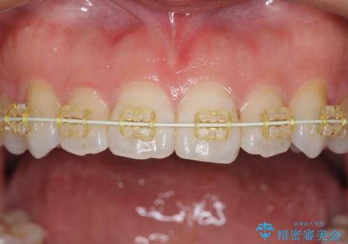 受け口傾向のマウスピース矯正 (ワイヤー治療を併用して)の治療中