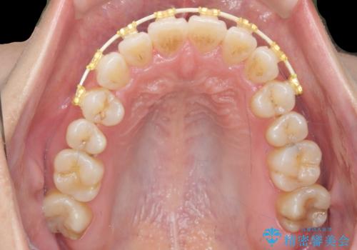 受け口傾向のマウスピース矯正 (ワイヤー治療を併用して)の治療中