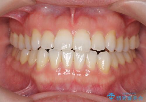 受け口傾向のマウスピース矯正 (ワイヤー治療を併用して)の治療中