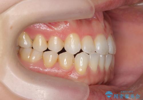 受け口傾向のマウスピース矯正 (ワイヤー治療を併用して)の治療中