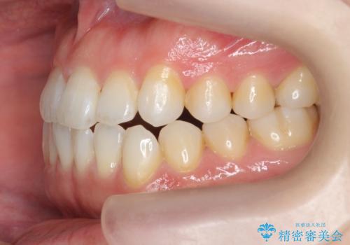 受け口傾向のマウスピース矯正 (ワイヤー治療を併用して)の治療中