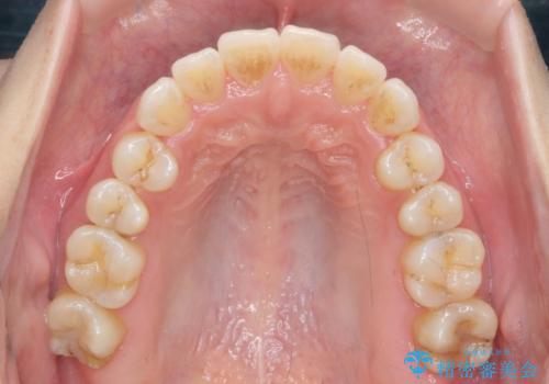 受け口傾向のマウスピース矯正 (ワイヤー治療を併用して)の治療中