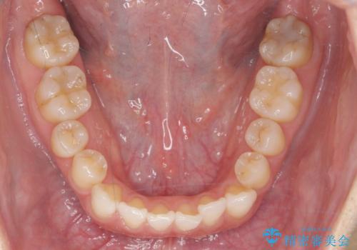 受け口傾向のマウスピース矯正 (ワイヤー治療を併用して)の治療中