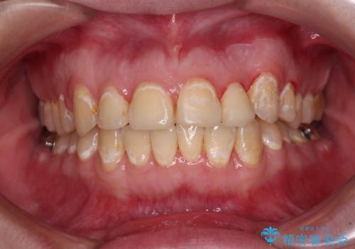 前歯のクロスバイトを改善　ワイヤー矯正を併用したインビザライン矯正の治療中