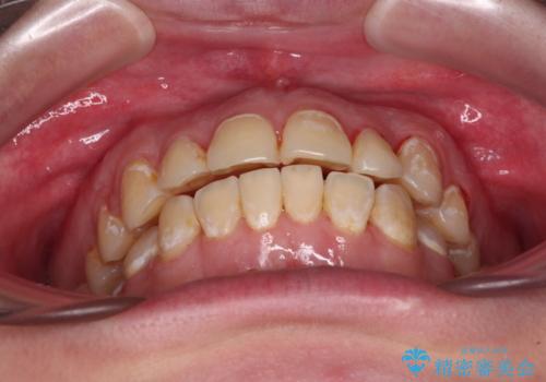 前歯のクロスバイトを改善 ワイヤー矯正を併用したインビザライン矯正の治療中