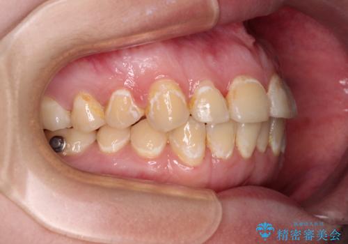 前歯のクロスバイトを改善 ワイヤー矯正を併用したインビザライン矯正の治療中