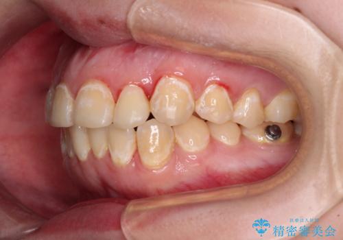 前歯のクロスバイトを改善 ワイヤー矯正を併用したインビザライン矯正の治療中